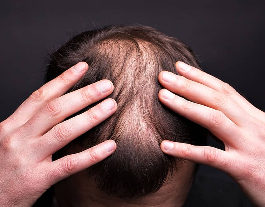 Can Hair Loss Be Stopped