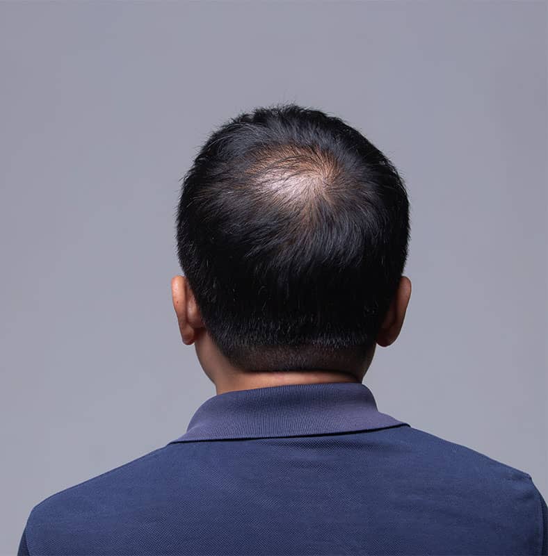 Causes of Men's Hair Loss