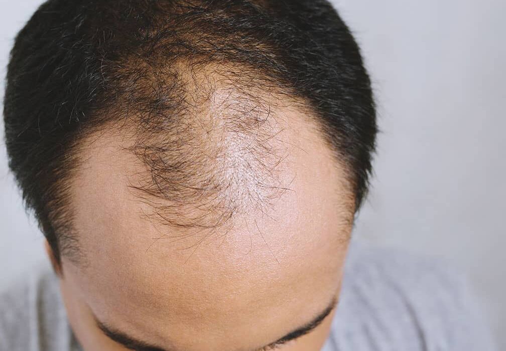 Hair Regrowth