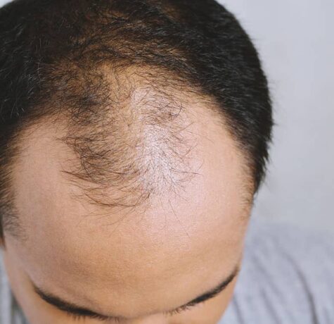 Hair Regrowth