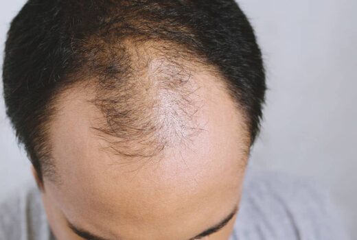 Hair Regrowth