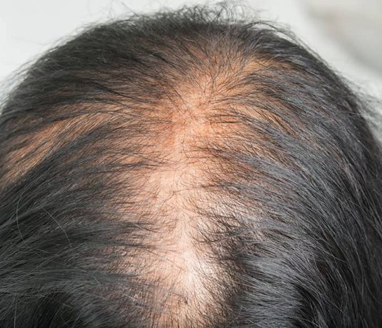 Hair Loss Treatments Women